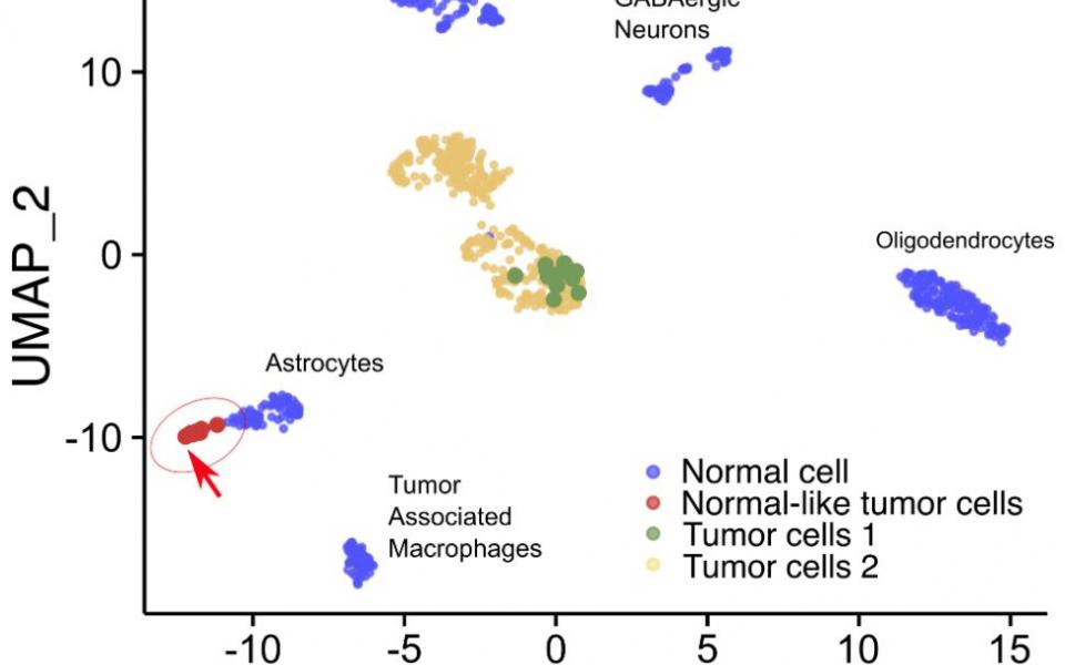 团队利用这种新技术识别出伪装为正常细胞(蓝色部分)的罕见脑肿瘤细胞 (红色箭咀所示)